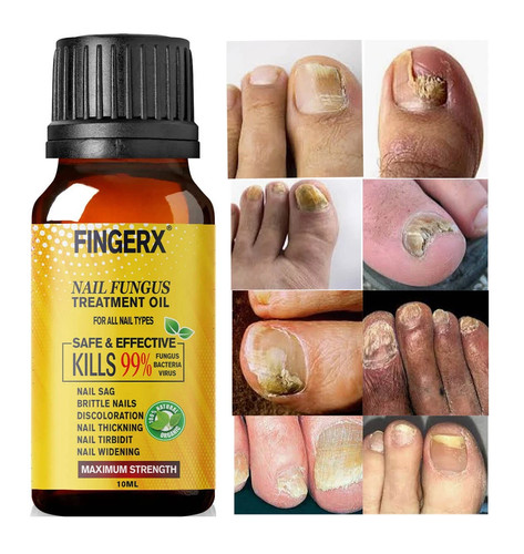 Beste nagelpilzinfektionen - beste,